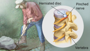 Herniated Disc