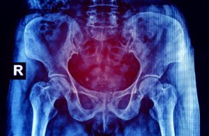 Pelvic Pain